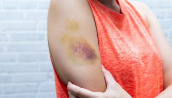 What to Do About Your Sexy Bruises